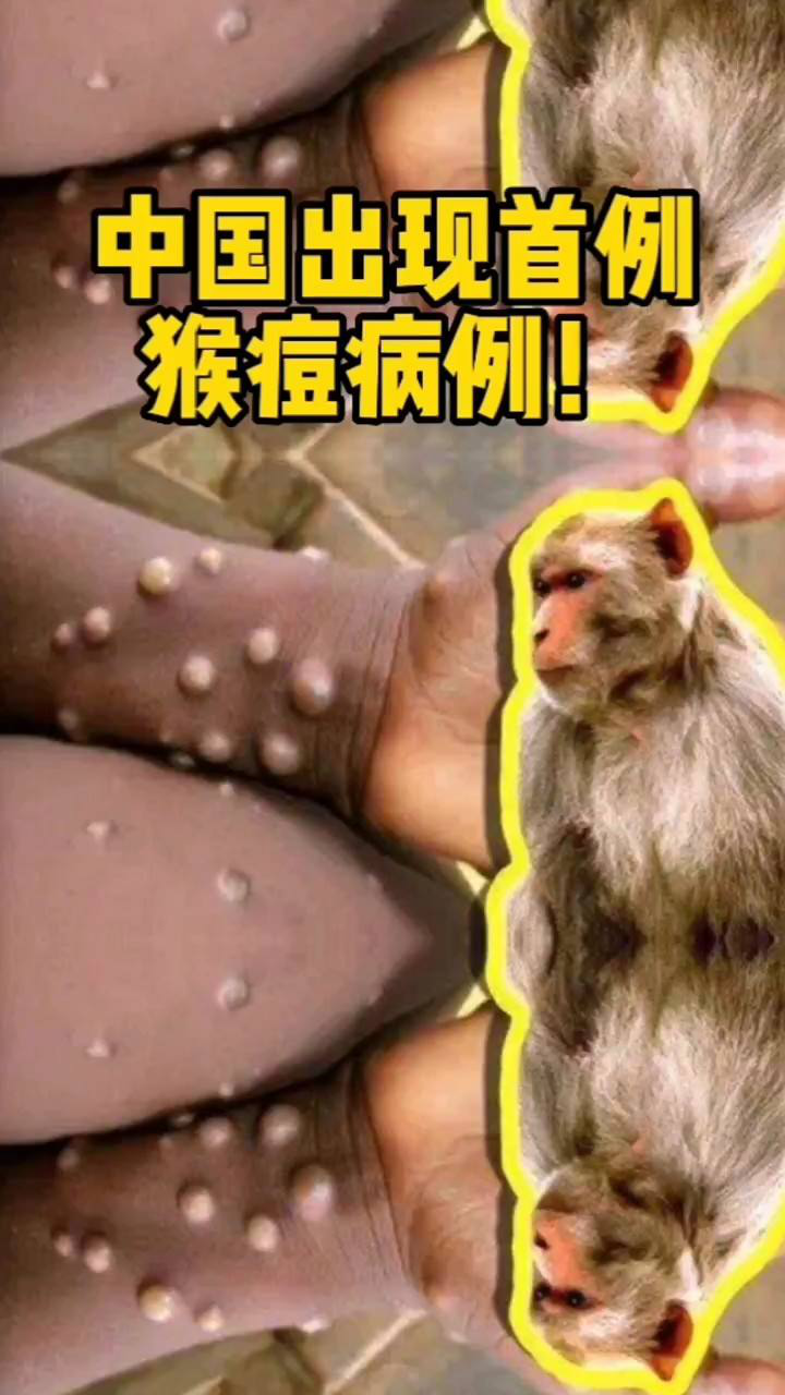 揭秘中國猴病毒，深入了解與應對